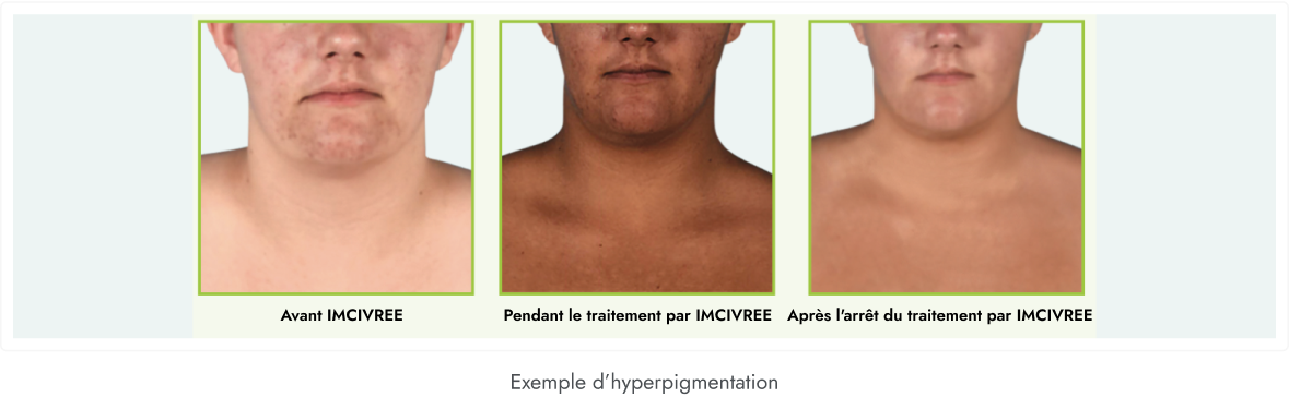 Frame 24 Trois visages côte à côte montrant les modifications de la peau du visage, étiquetés « Avant IMCIVREE », « Sous traitement par IMCIVREE » et « Après l’arrêt d’IMCIVREE ».
