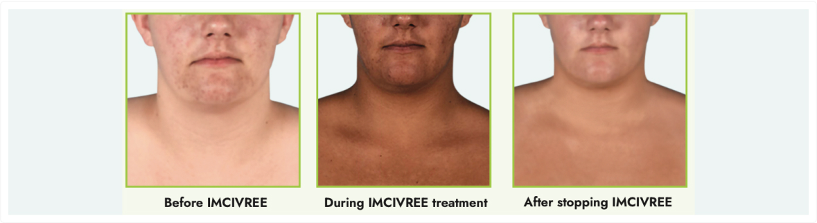 Frame 9377 Three side-by-side headshots showing facial skin changes labeled as "Before IMCVREE," "During IMCVREE treatment," and "After stopping IMCVREE.”
