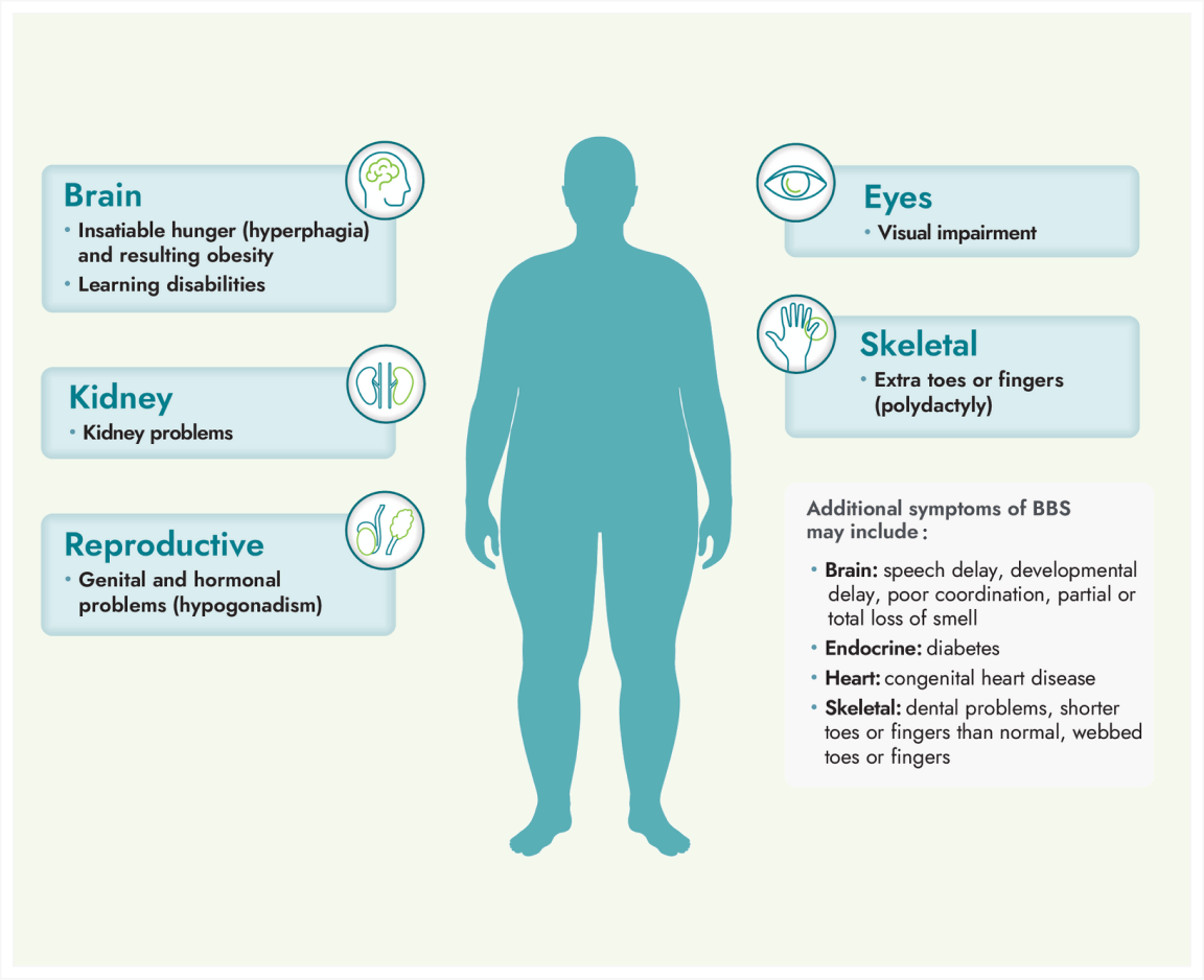 Frame 9446 An infographic about Bardet-Biedl Syndrome (BBS). A silhouette of a person with highlighted areas for the brain, eyes, kidneys, reproductive organs, and skeleton. Text boxes list related health issues, including obesity, learning disabilities, and visual impairment.